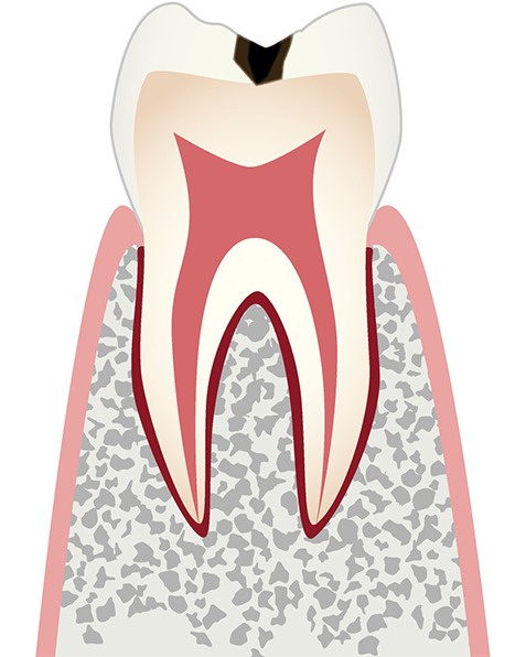 C1 エナメル質の虫歯