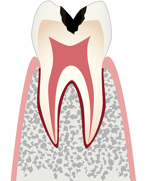 C2 象牙質の虫歯