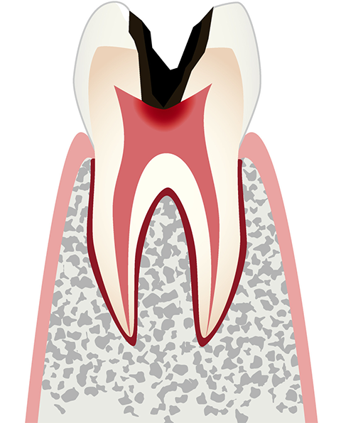 C3 歯髄の虫歯