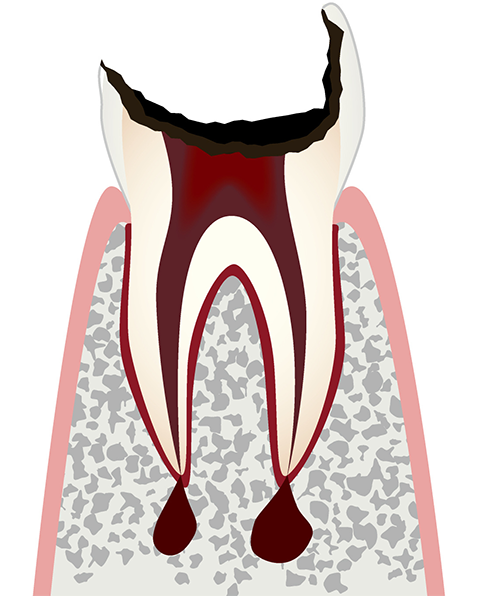 C4 歯髄が壊死した虫歯