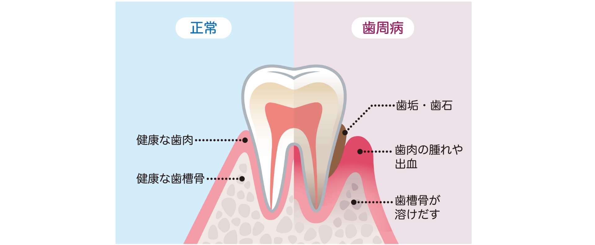 歯周病とは